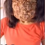 Psoriasis is a skin disease that causes a rash with itchy